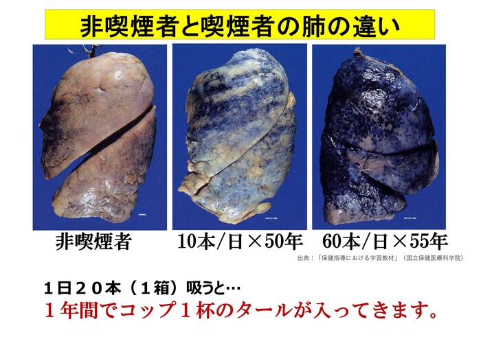 非喫煙者と喫煙者の肺